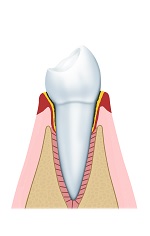 Geringe parodontitis